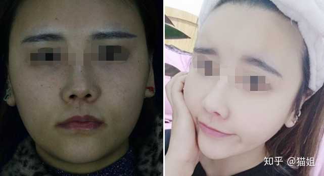 下颌角削骨颧骨内推手术 成都有没有推荐的医生 知乎 下颌角削骨颧骨内推手术 成都有没有推荐的医生 知乎