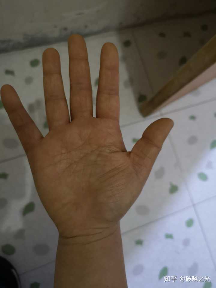 手掌肥肥的可以减吗?