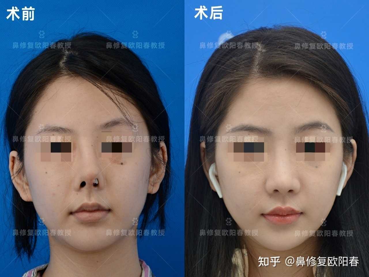 欧阳春鼻综合修复