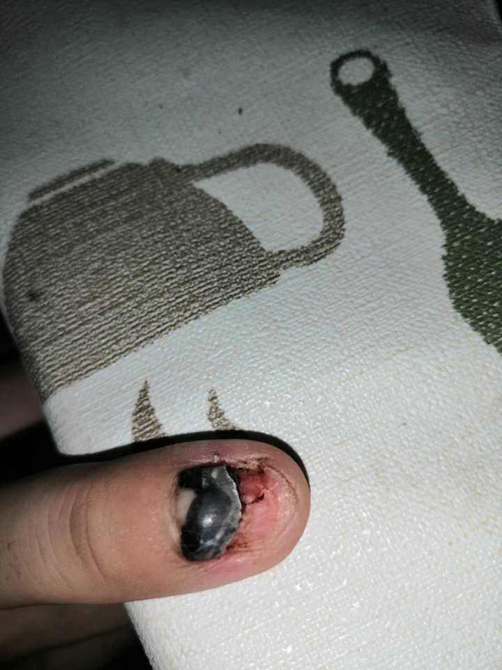 手指甲被砸上指甲里变黑怎么办