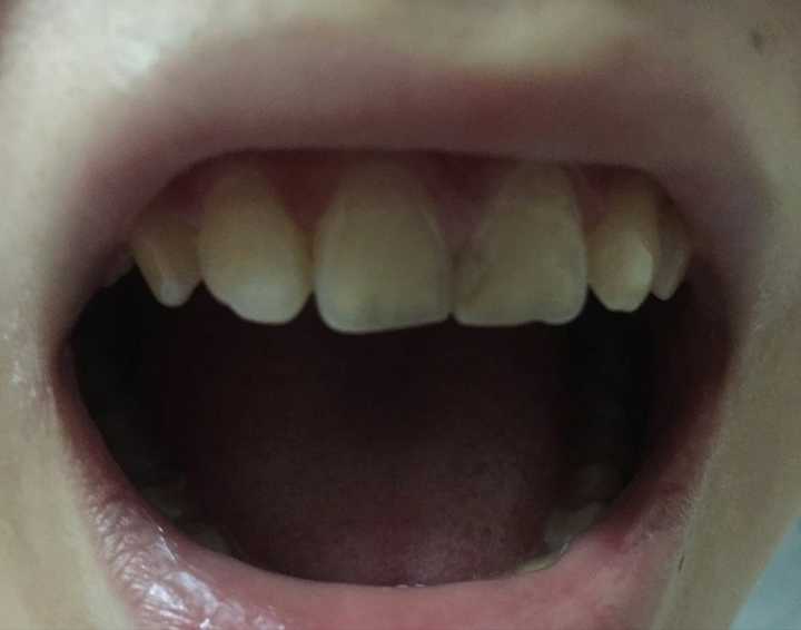 牙齿中间有黑色缝隙图片