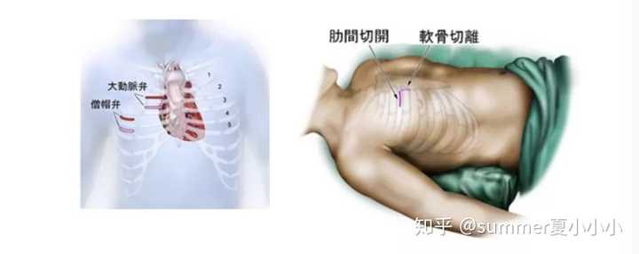 心脏搭桥手术真的有效安全吗 知乎 心脏搭桥手术真的有效安全吗 知乎