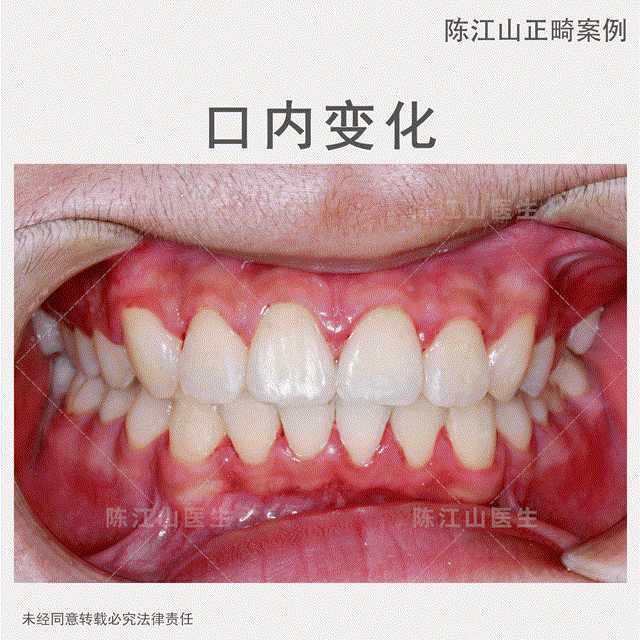 iii度深覆合 嘴突 牙齿不齐