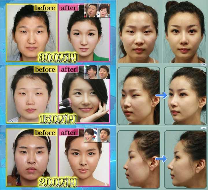 怎么才能去日本整容 知乎