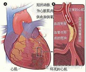 心肌梗死位置记忆图图片