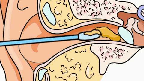 經常用棉籤掏耳朵真的會堵塞耳道嗎