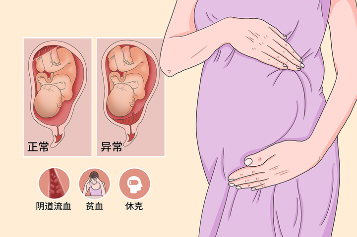 六出花 的想法: #知招妈妈# 前置胎盘很危险,是如何诊断… - 知乎