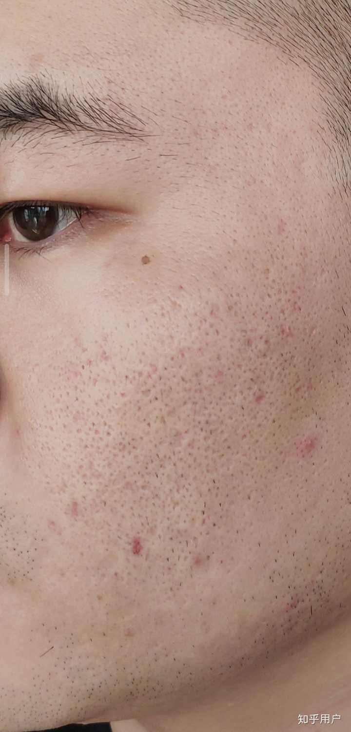 点阵激光去痘坑的效果如何 知乎