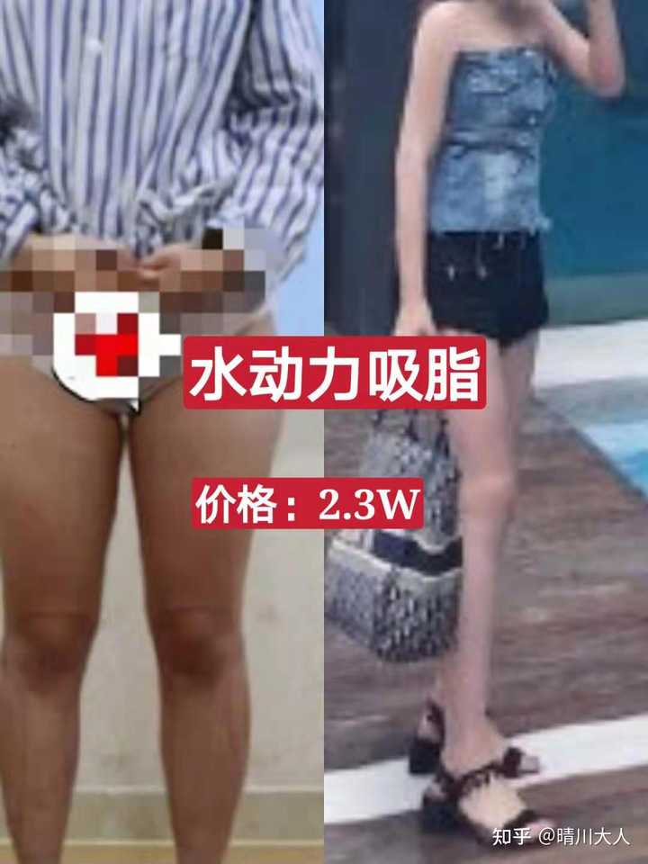 合肥吸脂价格_合肥专业吸脂整形手术_合肥三甲整形医院吸脂