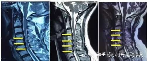 得了颈椎病是不是就废了 知乎 得了颈椎病是不是就废了 知乎
