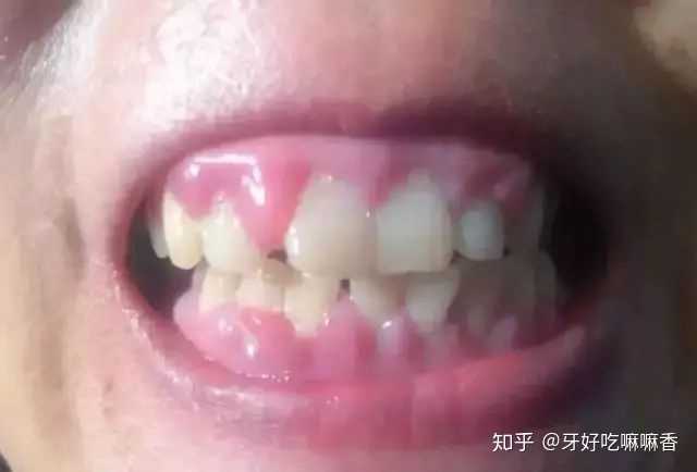 洗牙的过程是怎样的 洗牙后有哪些需要注意的 知乎 洗牙的过程是怎样的 洗牙后有哪些需要注意的 知乎