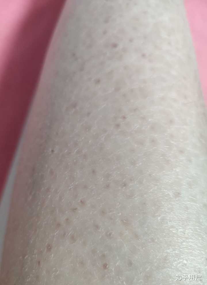 得了鱼鳞病是一种怎样的体验 知乎