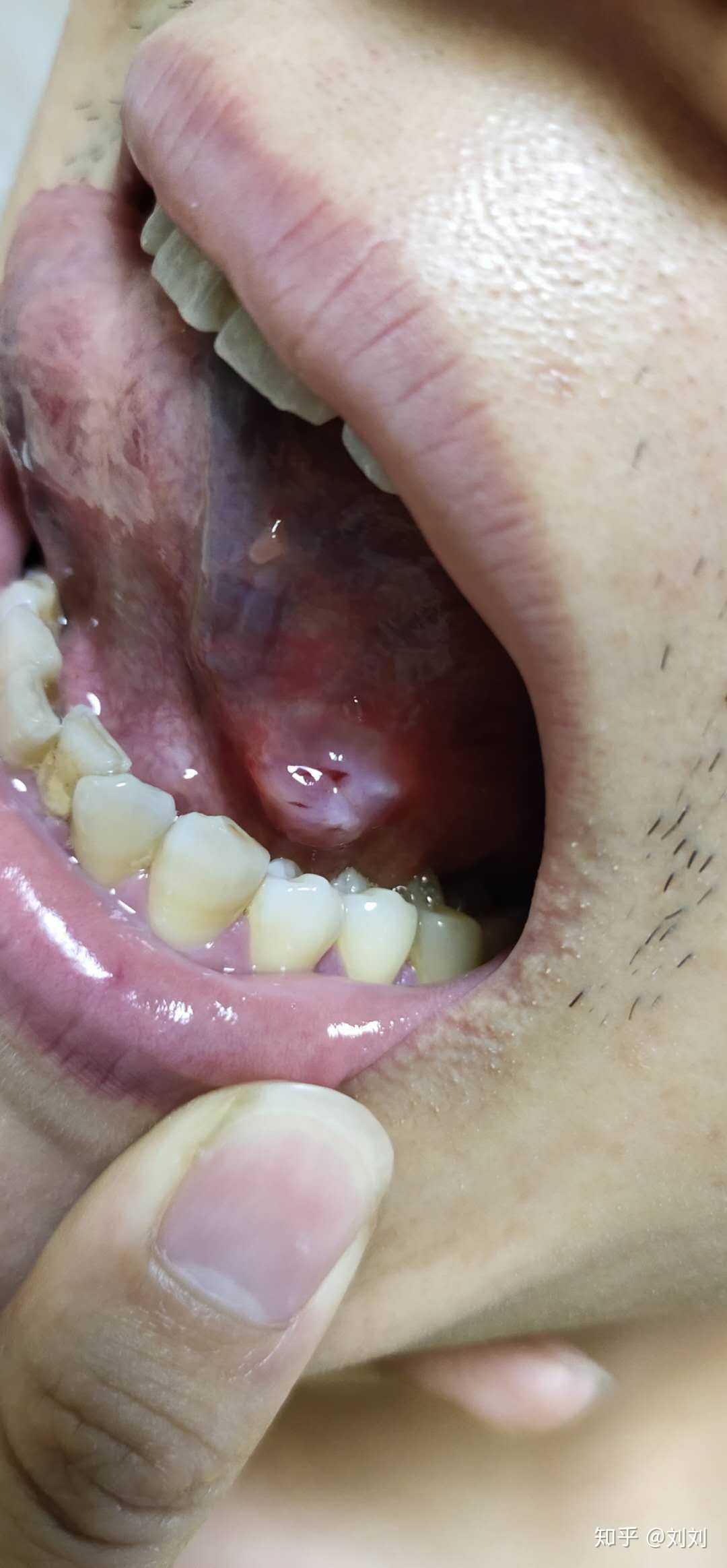 舌头底下口腔溃疡图片