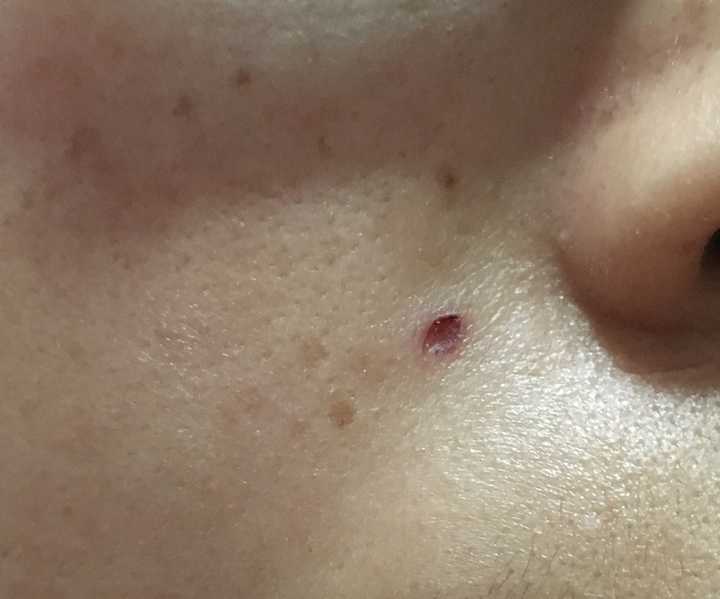 有没有做过激光脱毛的女生能否交流一下