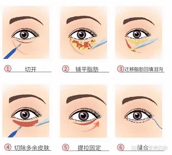 做眼袋时选择眶隔脂肪释放好吗？它的特点是什么呢？ - 知乎
