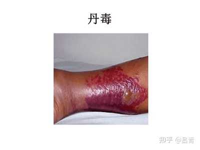 丹毒是什么病? - 知乎
