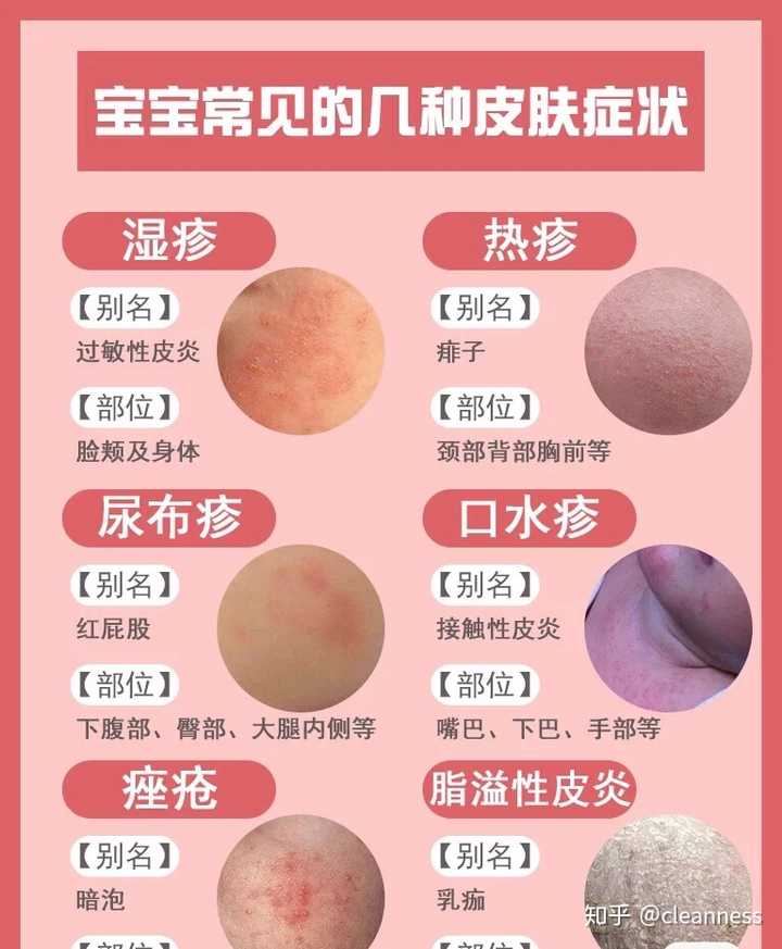 新生婴儿长湿疹怎么办？