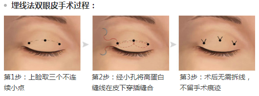 双眼皮价格表图片_全切双眼皮价格_双眼皮的价格