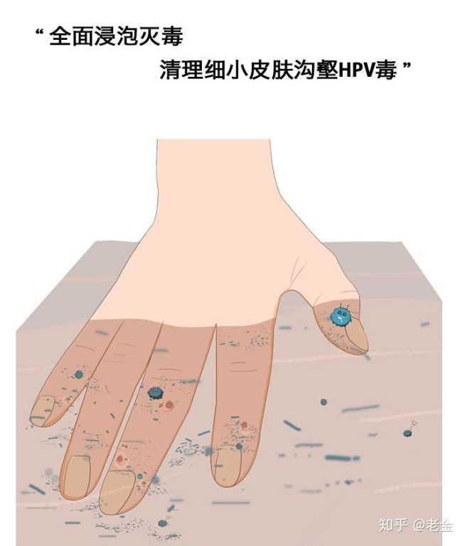 瘊子(即疣)是怎么形成的? 该如何医治? - 知乎