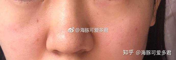 男士如何去黑头 知乎