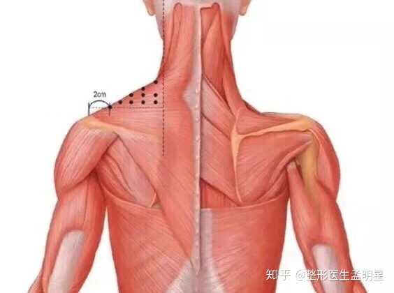 瘦肩针真的安全吗 知乎