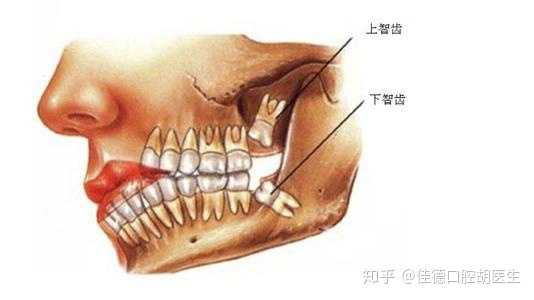 那要不忍忍疼去把智齒拔了?