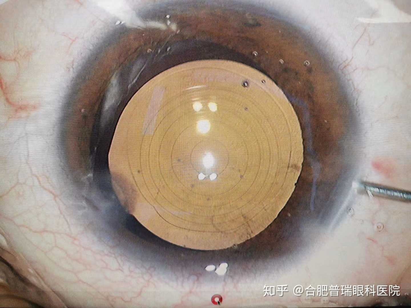 三焦点人工晶体