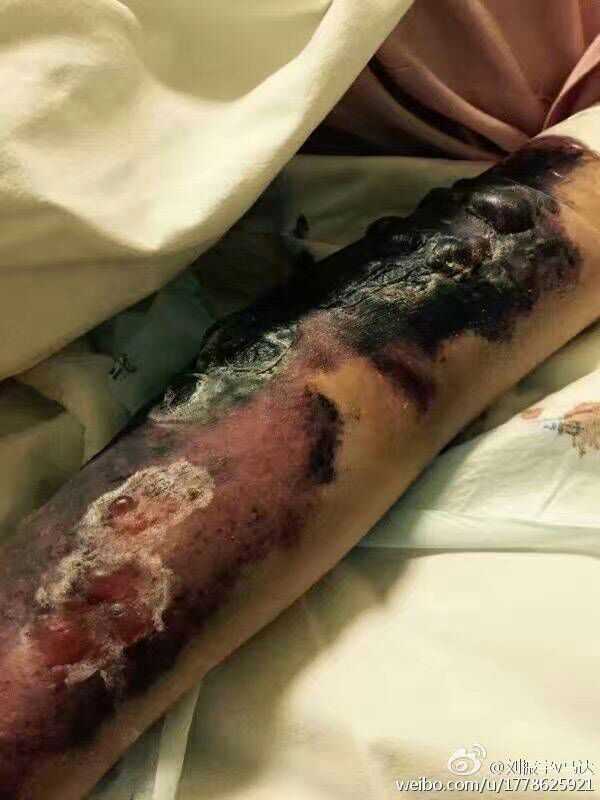 老公27岁查出肝癌晚期我现在该怎么办