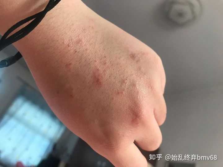 全身基本都有疹子医生说是泛发性湿疹，西医中医都看了但是还没好，怎么办？