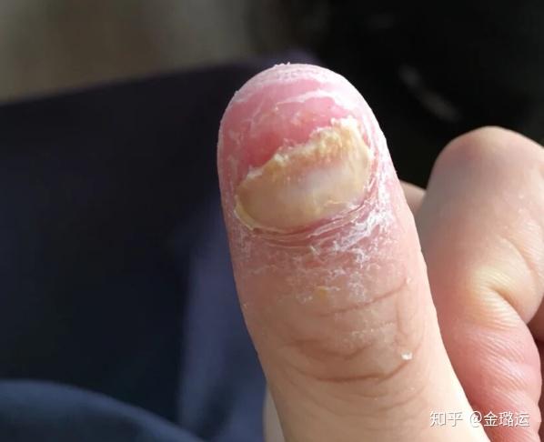 手上灰指甲初期症状图片