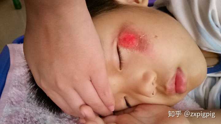擦伤会留疤吗 知乎