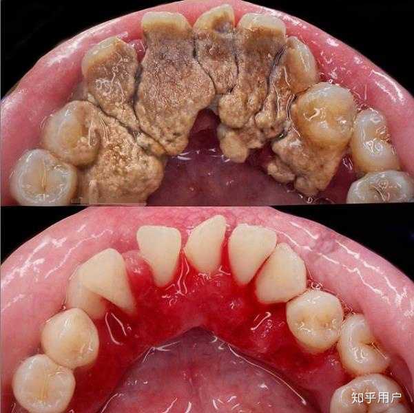 请问洗牙能洗掉蛀牙的菌斑吗