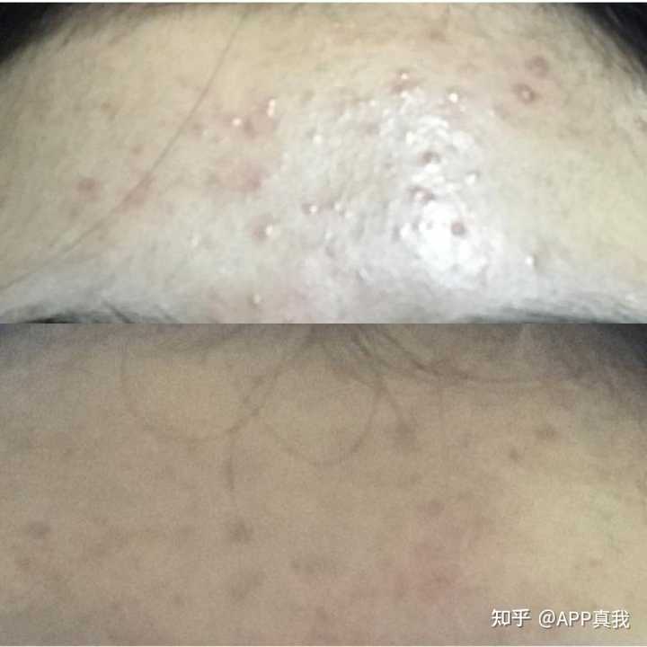 痘印心得经验_痘印心得经验_痘印心得经验