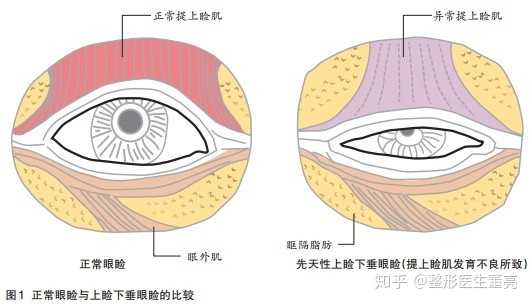 重症肌無力是否屬於重大疾病?