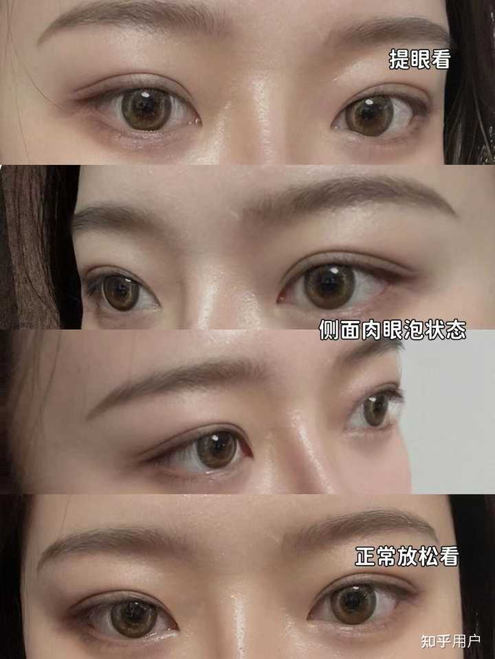 双眼皮埋线价格_双眼皮法埋线价格多少_埋线法双眼皮价格