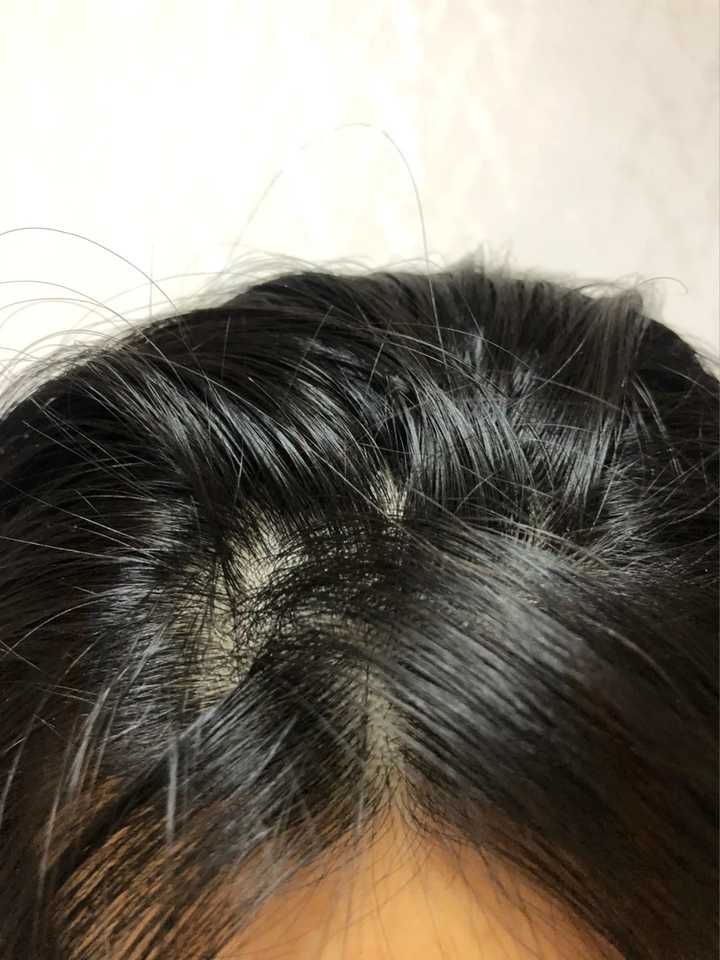 女生掉头发特别厉害该怎么解决？