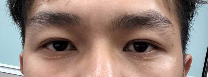 郑大一附院割双眼皮价格_全切双眼皮价格_双眼皮的价格