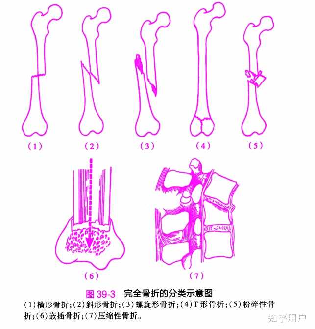 骨折的基本类型以及其处理方法有哪些? - 知乎