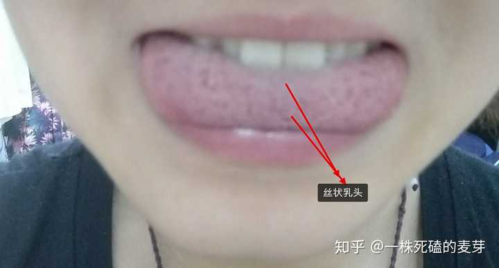舌苔到底是什么？为什么舌苔厚就是积食了？ - 知乎
