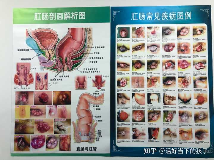 为什么同样的痔疮手术,有的地方住两天有的地方住十几天?