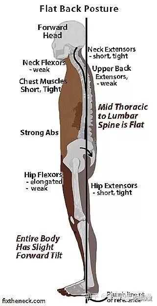 怎么矫正骨盆后倾 知乎