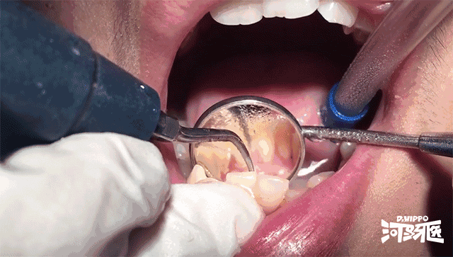 洗牙的过程是怎样的 洗牙后有哪些需要注意的 知乎