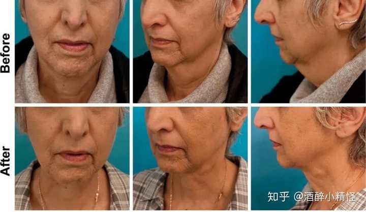 可以请学医或者医美的人谈谈溶脂针的效果或危害吗 打过的人献身说法最好了 知乎 可以请学医或者医美的人谈谈溶脂针的效果或危害吗 打过的人献身说法最好了 知乎