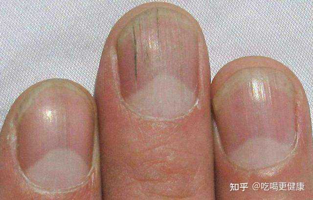 肝不好的人,通常有什么症状? - 知乎