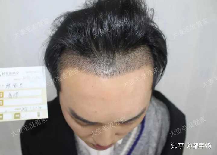 M型脱发该如何拯救 知乎 M型脱发该如何拯救 知乎