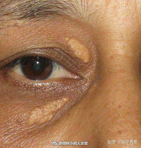 我国心梗每年新发病例约50万