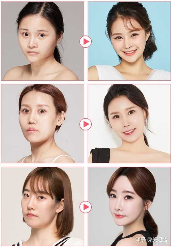 轮廓三件套后术前术后对比