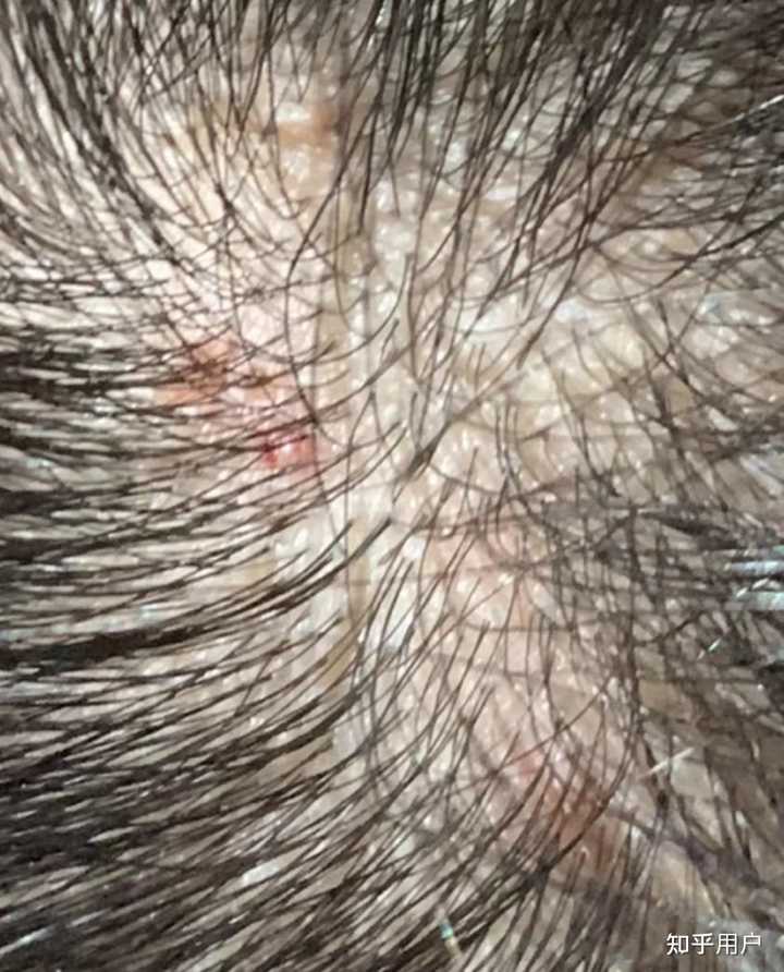 头部脂溢性皮炎,求推荐的洗发水,很多洗发水都过敏? - 知乎