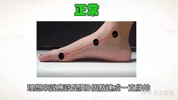 平时穿什么鞋都磨前掌,剧烈运动足弓疼,请问这算不算扁平足?