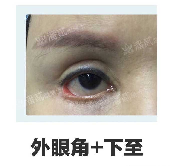 下置,外眼角不对称,外眦睑缘外翻,明显的疤痕牵拉眼角,露红,睑球分离